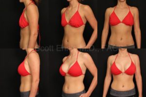 About Silicone Breast Implants — accompanying illustration or photograph