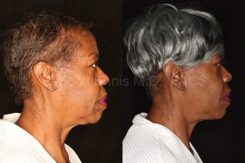 Suture Suspension Neck Lift — accompanying illustration or photograph