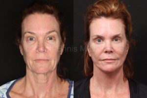 Brow Lift vs Upper Blepharoplasty — accompanying illustration or photograph