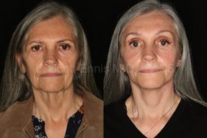 Brow Lift vs Upper Blepharoplasty — accompanying illustration or photograph
