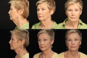 Brow Lift vs Upper Blepharoplasty — accompanying illustration or photograph