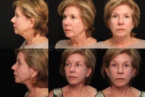 Brow Lift vs Upper Blepharoplasty — accompanying illustration or photograph