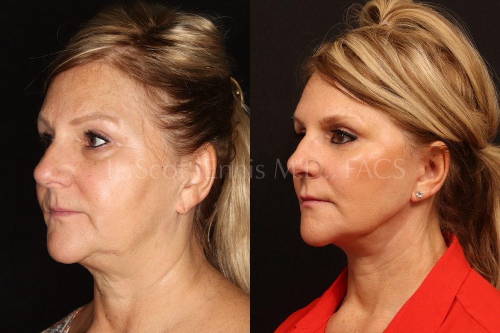 Buccal Fat Pad Treatment Process — accompanying illustration or photograph