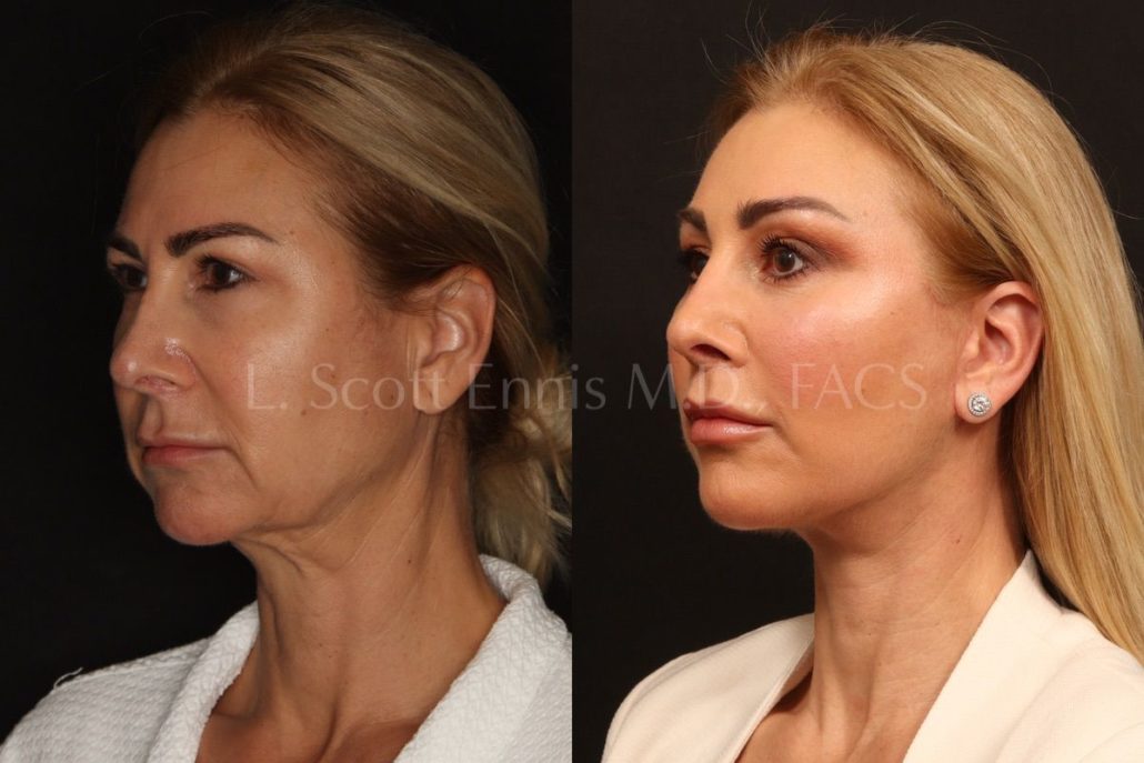 Buccal Fat Pad Treatment Process — accompanying illustration or photograph