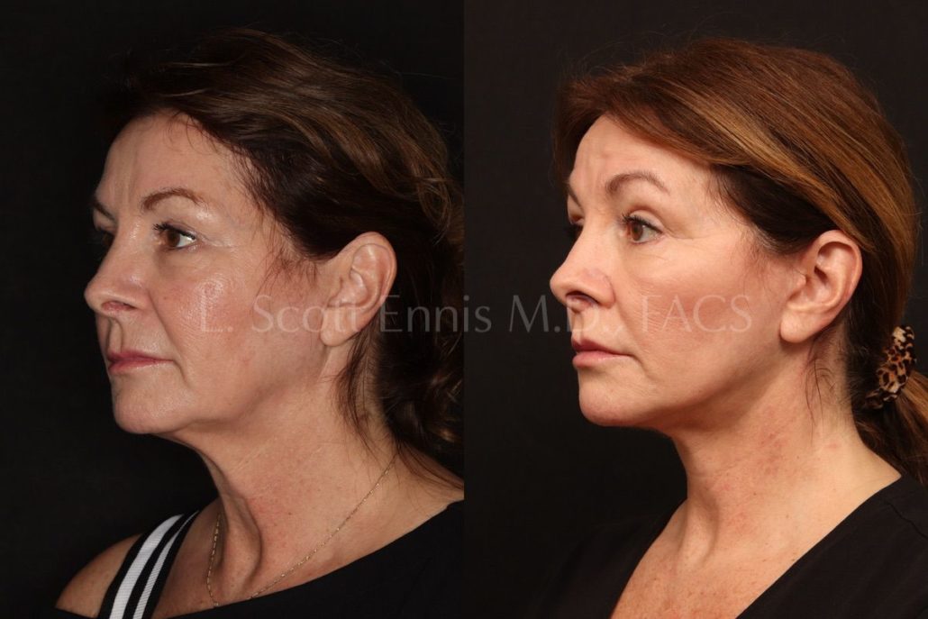 Buccal Fat Pad Treatment Process — accompanying illustration or photograph