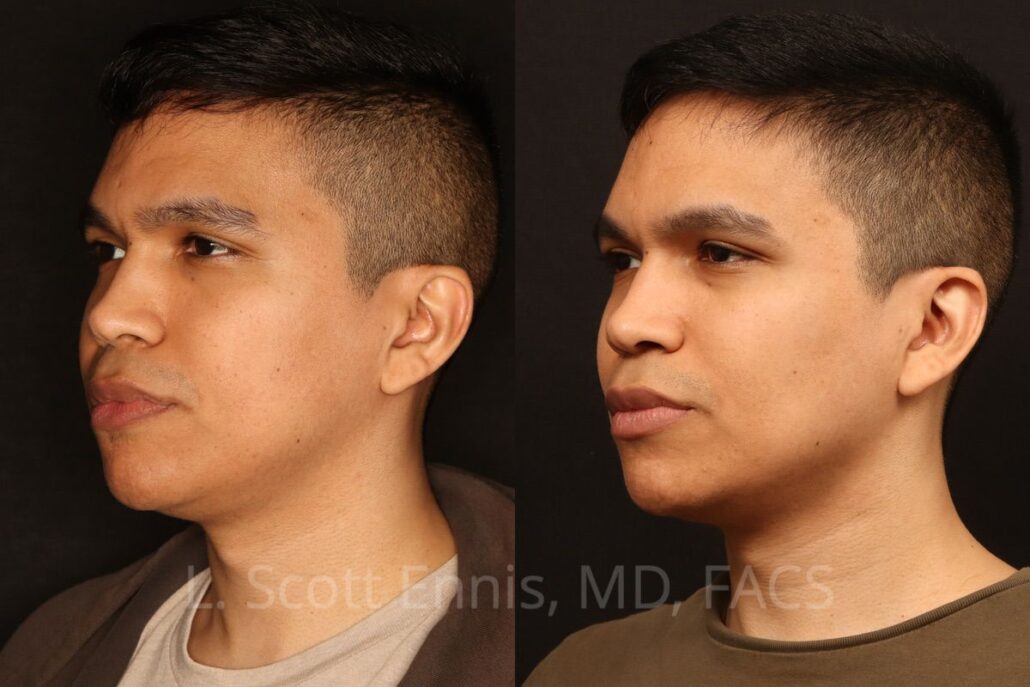 Buccal Fat Pad Treatment Process — accompanying illustration or photograph