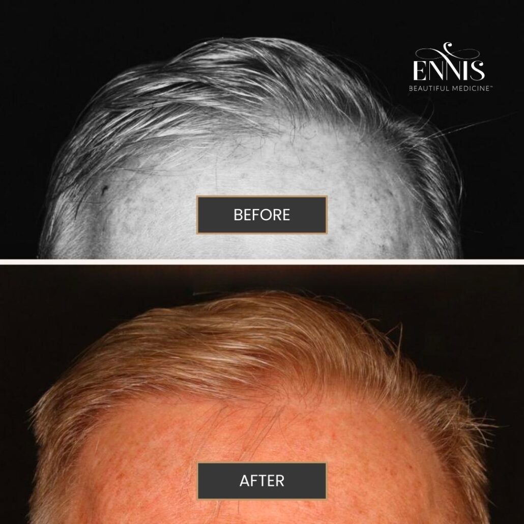About Hair Transplants FUE vs FUT — accompanying illustration or photograph