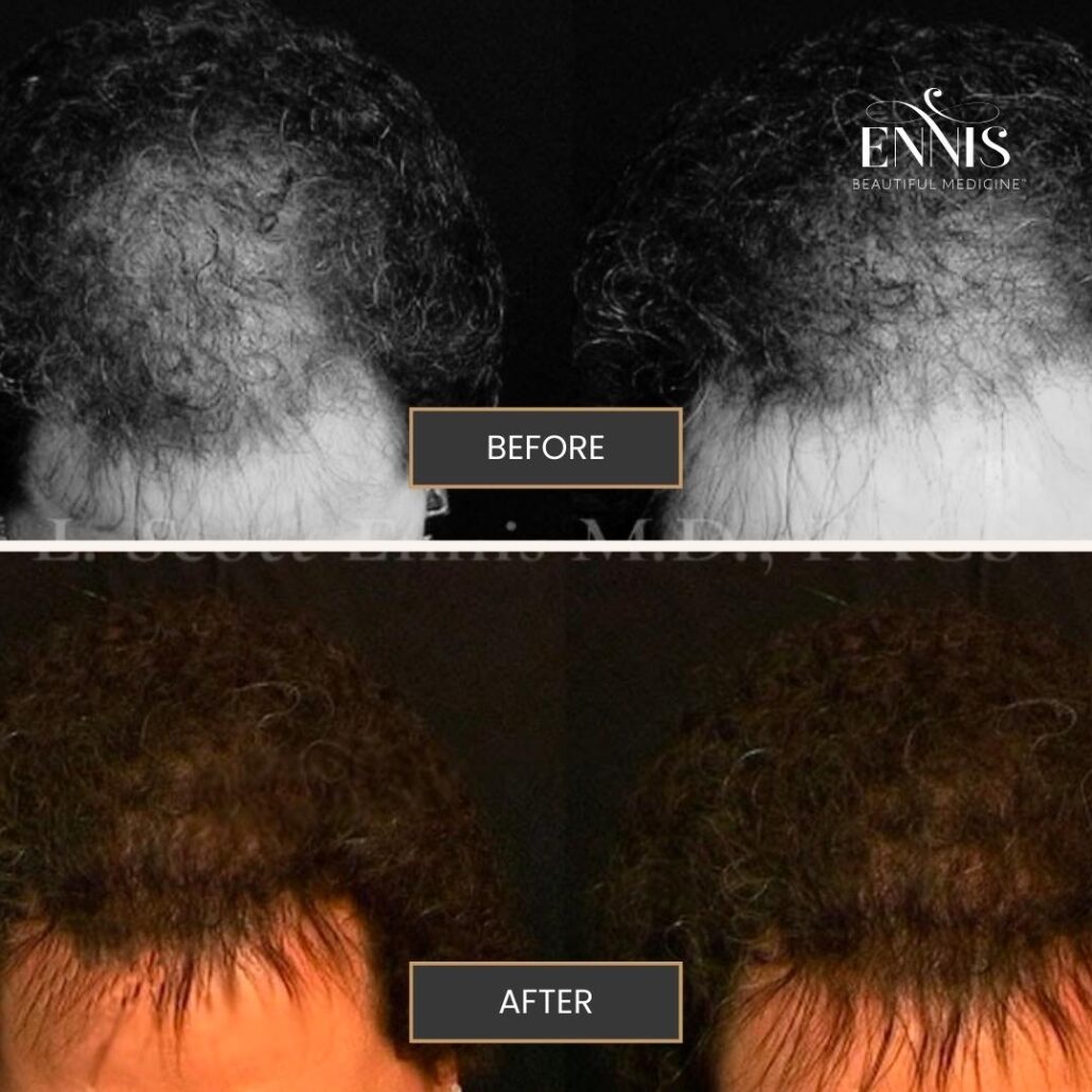 About Hair Transplants FUE vs FUT — accompanying illustration or photograph