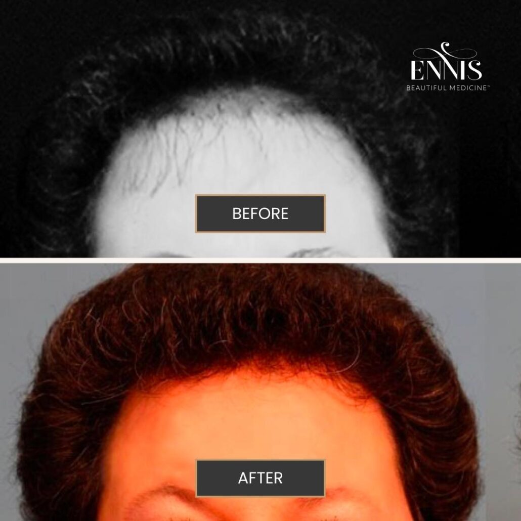 About Hair Transplants FUE vs FUT — accompanying illustration or photograph