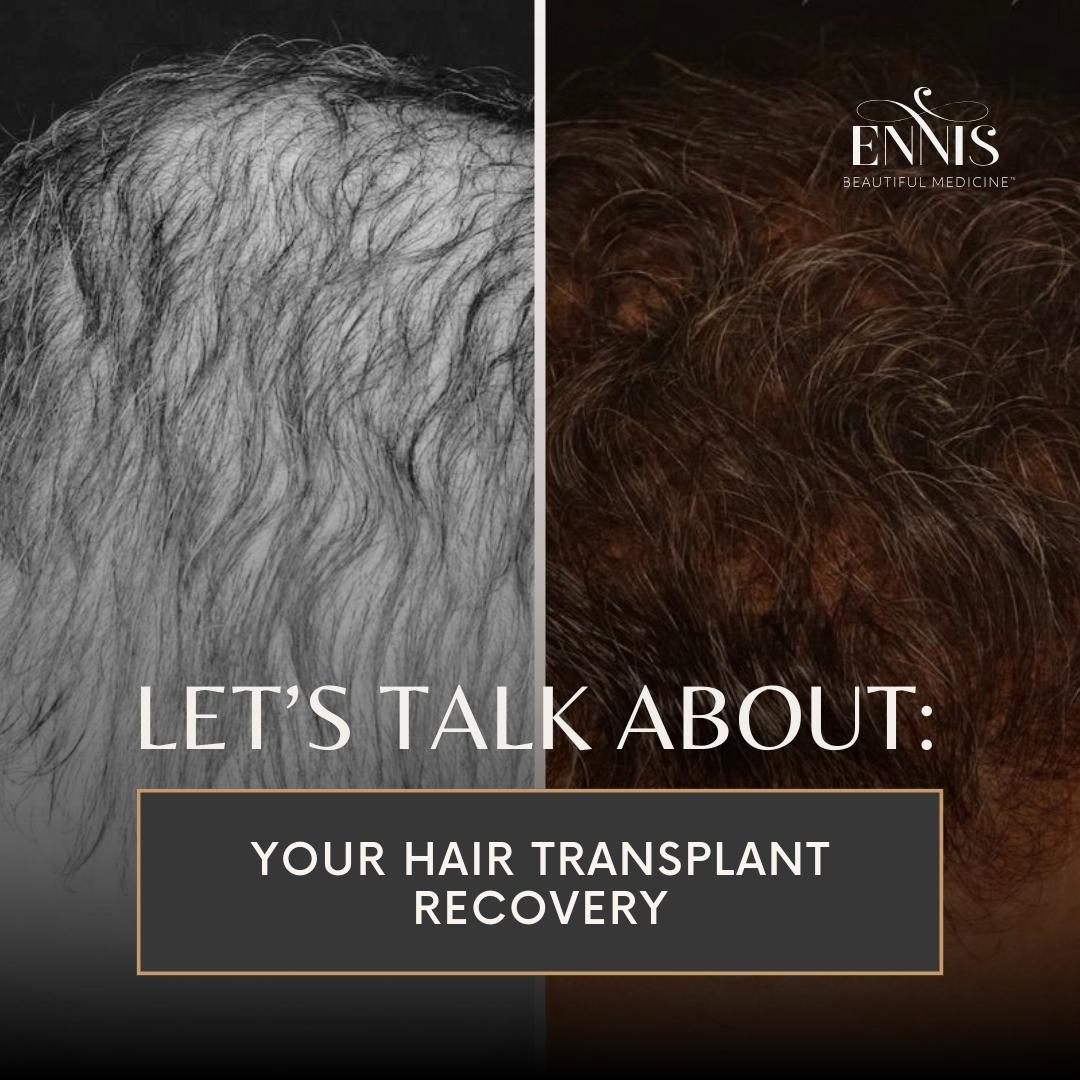 Hair Transplant Recovery & Hair Regrowth Timeline — accompanying illustration or photograph