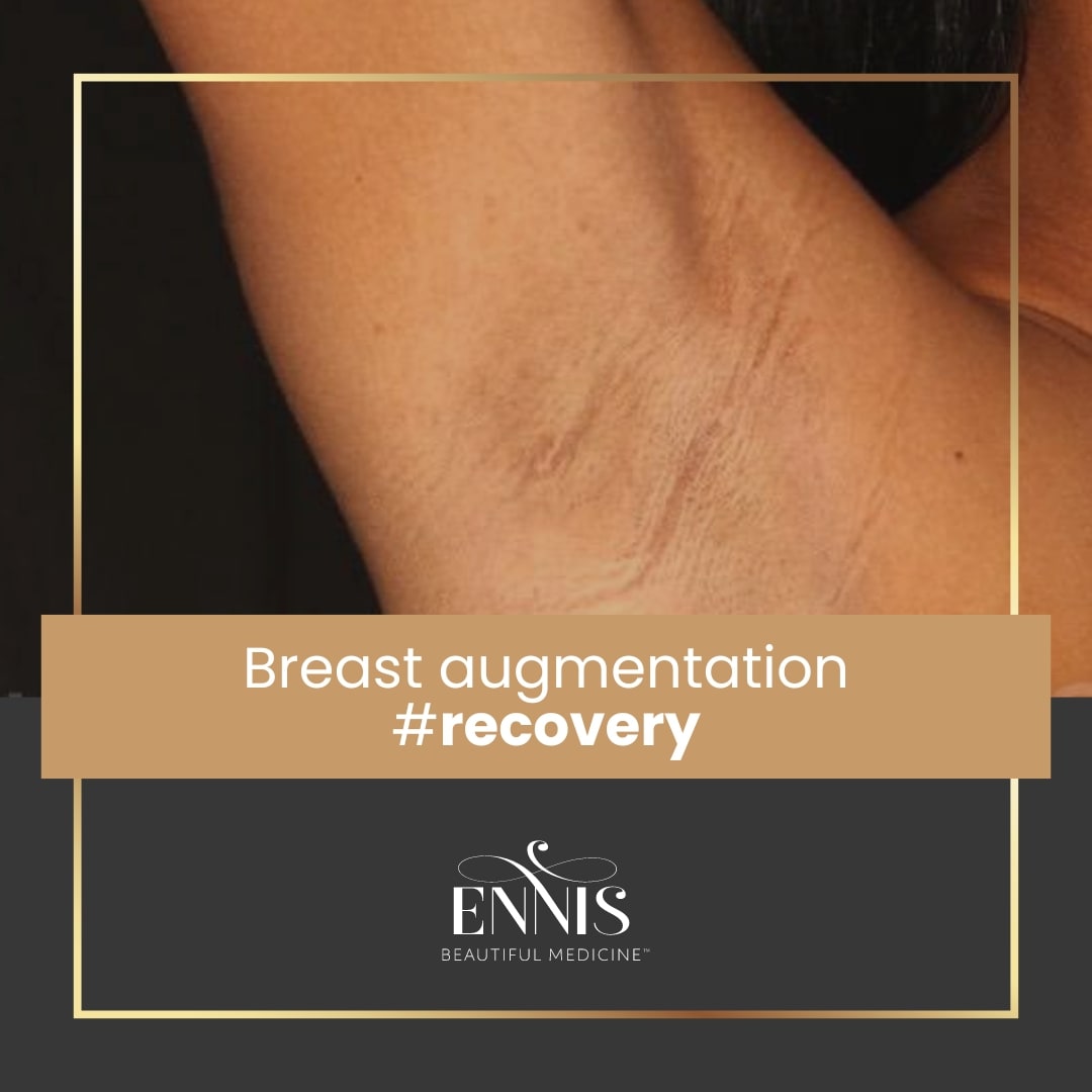 Breast Augmentation Timeline and Tips For Recovery — accompanying illustration or photograph