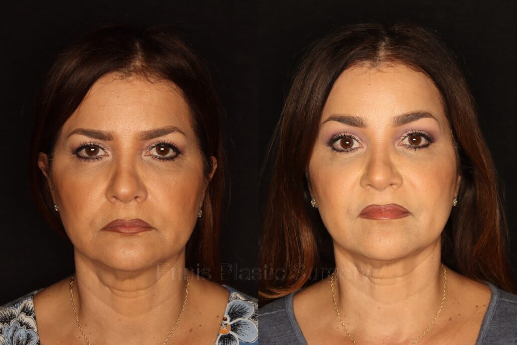 baby-brow-lift-before-after-ennis-plastic-surgery-boca-raton-florida