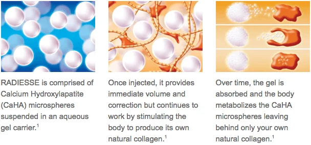 Three conceptual panels showing CaHA microspheres in gel, collagen around the microspheres, and gradual absorption of the material.
