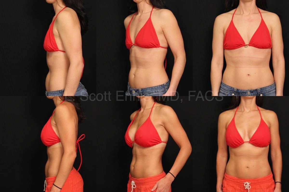 Combined before-and-after breast augmentation photographs, first featured case
