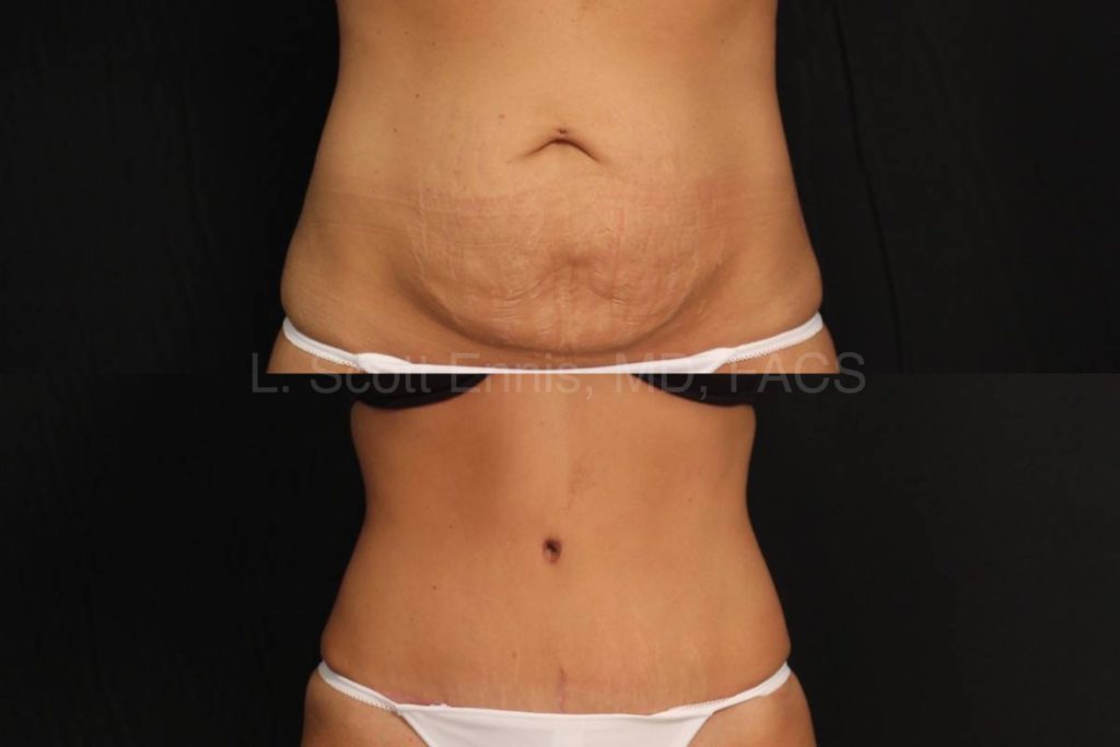 Abdominoplasty Before and After