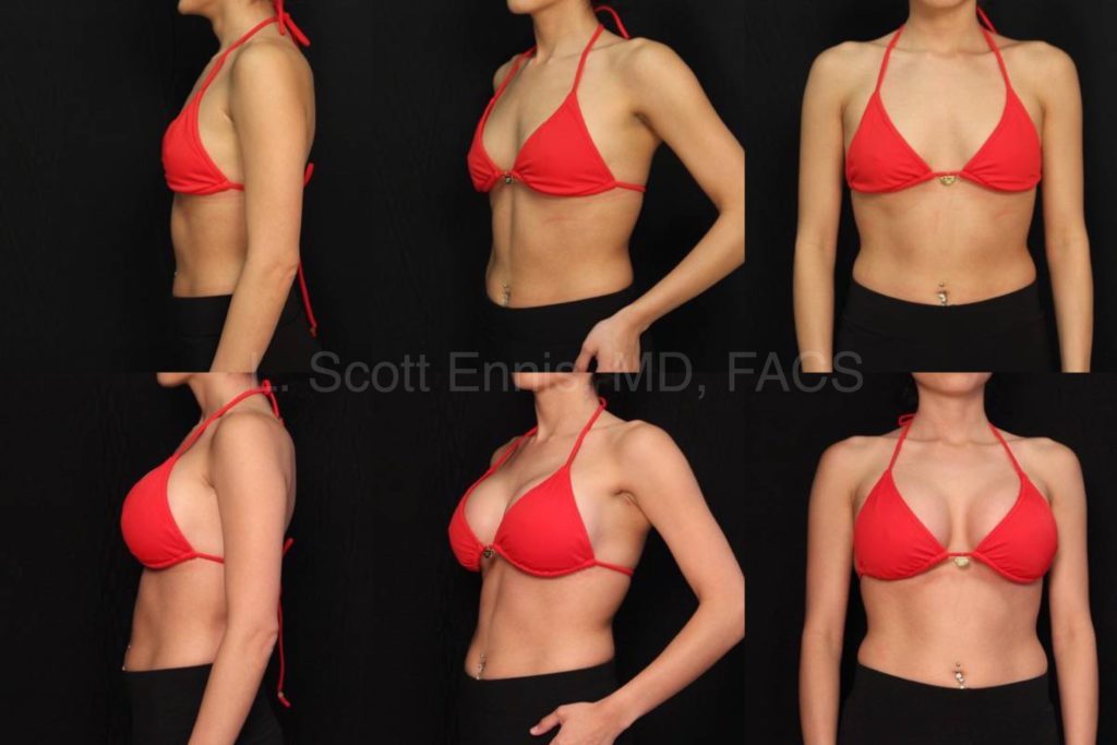 Breast Augmentation Mod+ gel