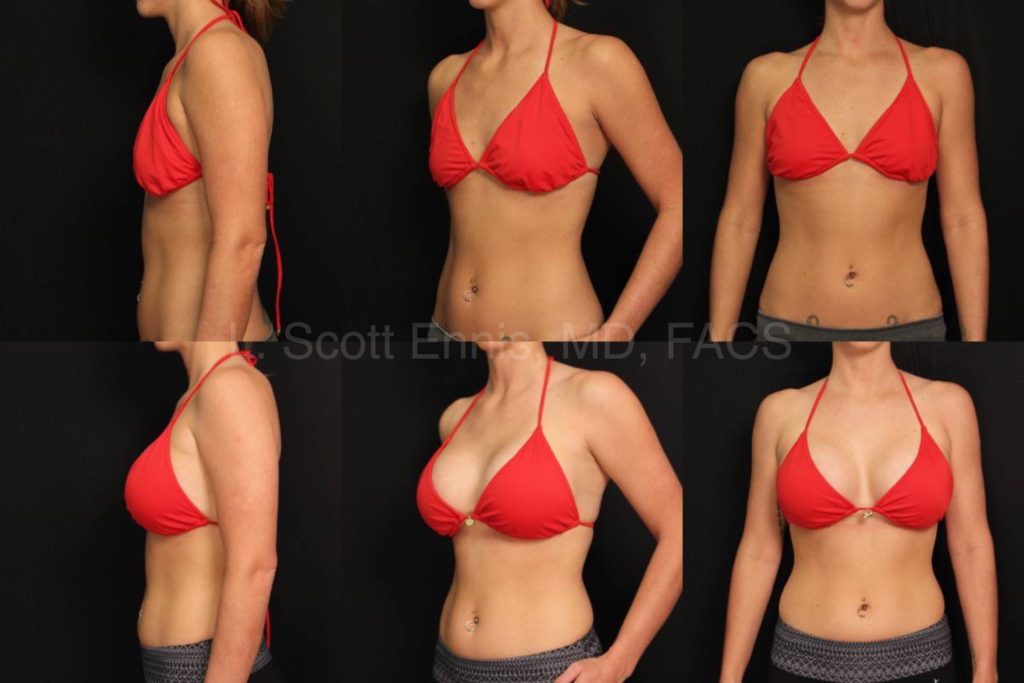 Breast Augmentation