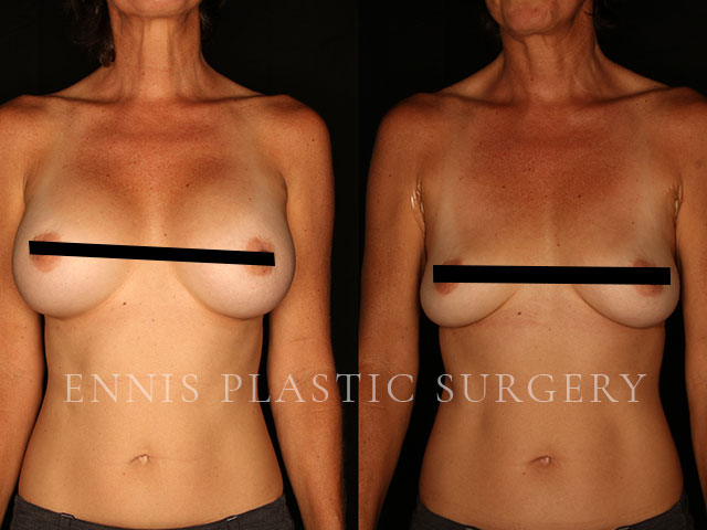 Breast implant removal