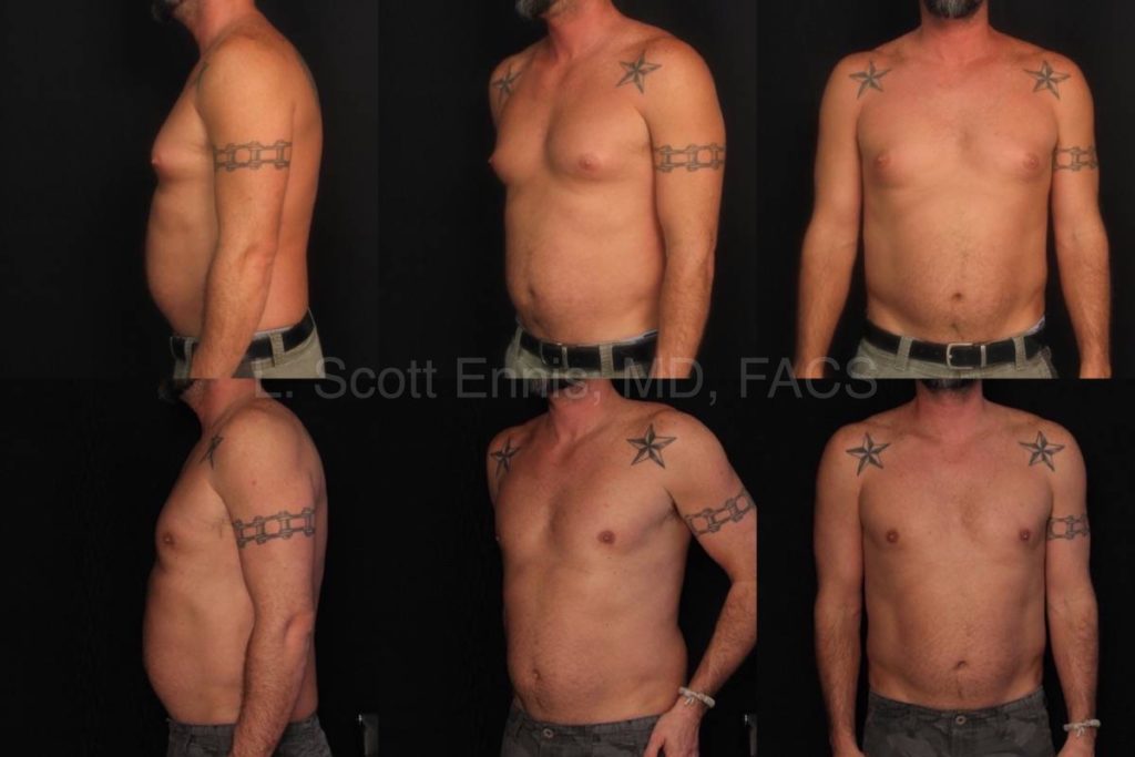 Gynecomastia Male Breast Reduction Surgery