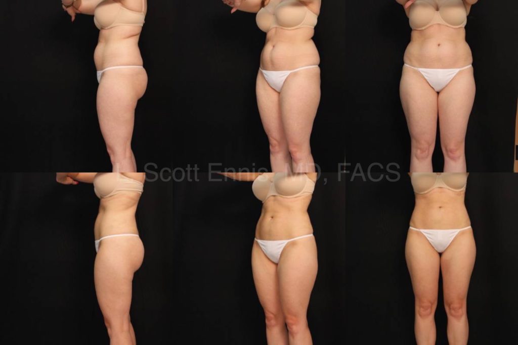 Liposuction of abdomen and hips