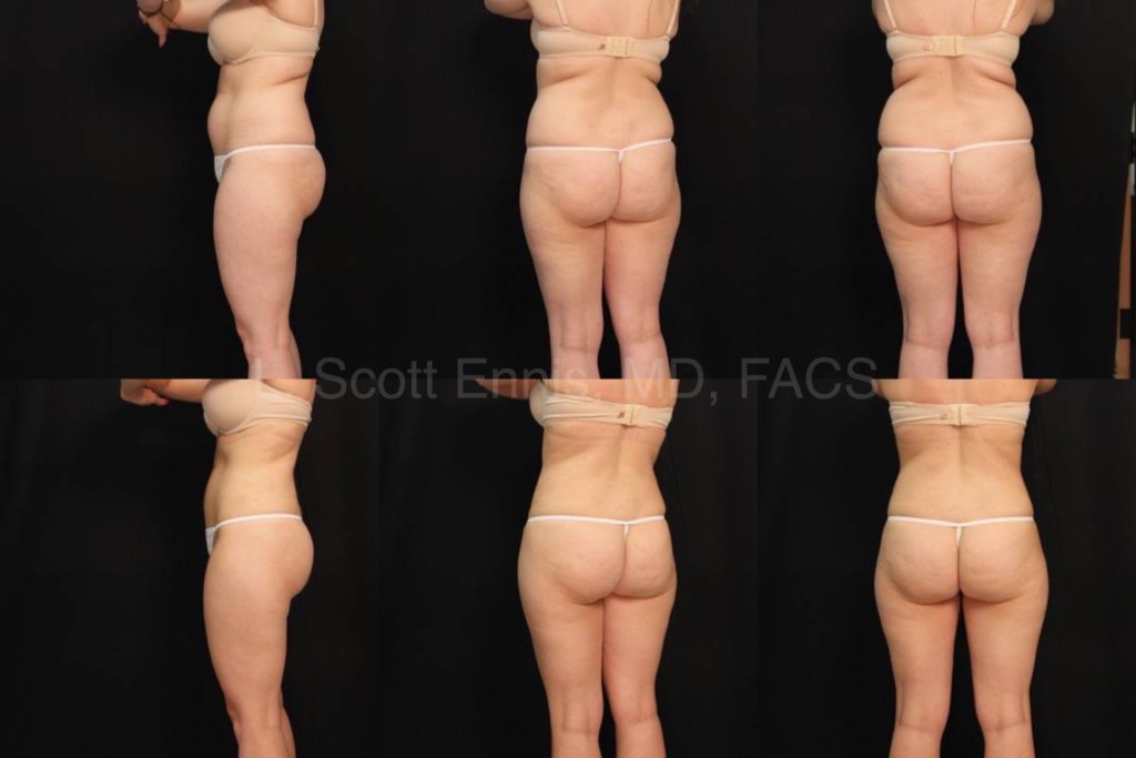 Liposuction of the abdomen and hips