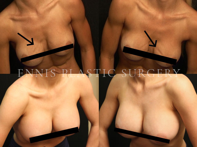 Saline Rippling to Silicone Breast implant exchange