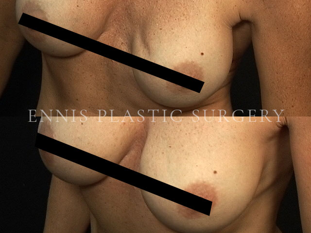 Saline to Silicone Breast implant Rippling exchange