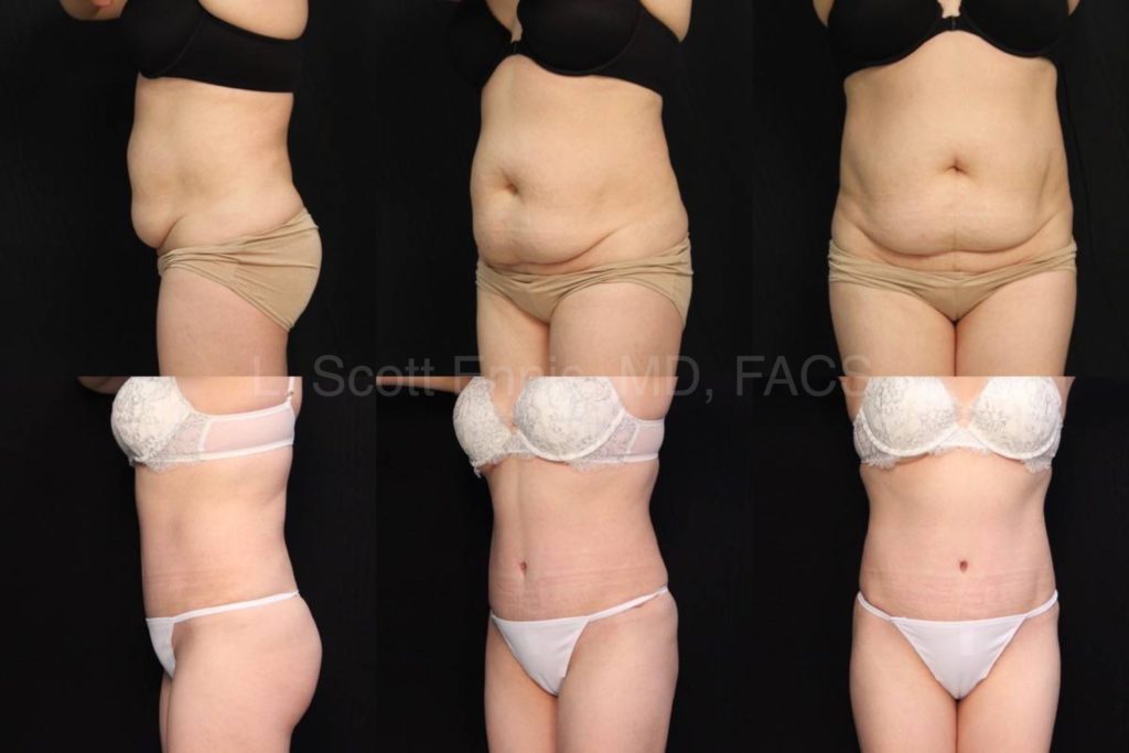 Compression Garments for Better Recovery After Tummy Tuck in Miami