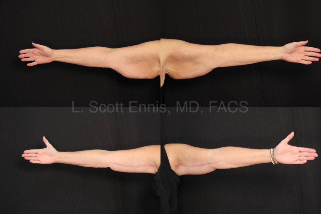 Arm lift Bilateral Brachioplasty 55yo 5_3_ 161lb Before and After Ennis Plastic Surgery Palm Beach Boca Raton Destin Miami 846681
