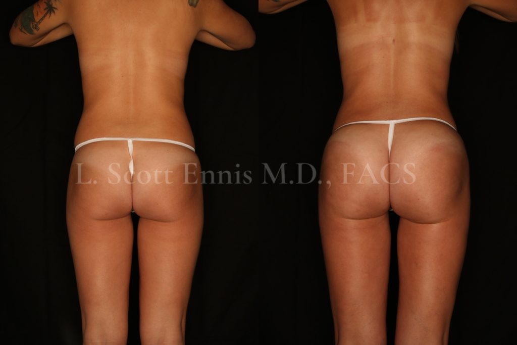 BBL Brazilian Butt LIft Lipoinfiltration to the butt 28yo 5'2' 115lbs Dr Ennis Destin Boca Raton Palm Beach Miami 37728