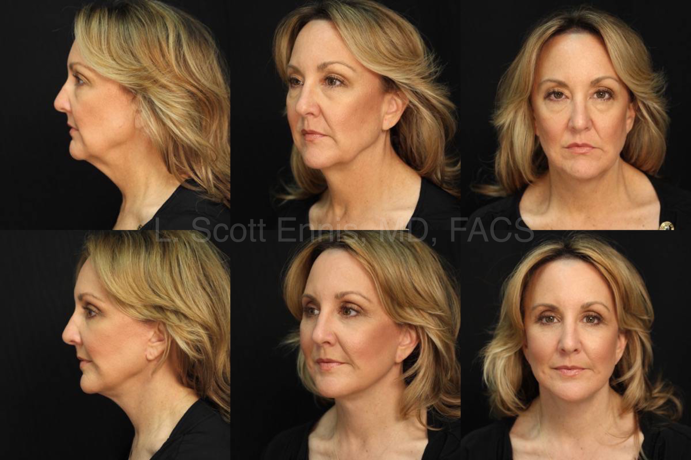 Before and After face lift eye lid lift blepheroplasty buccal fat pad removal mini Ennis Plastic Surgery Palm Beach Boca Raton Destin Miami Fort Lauderdale Florida
