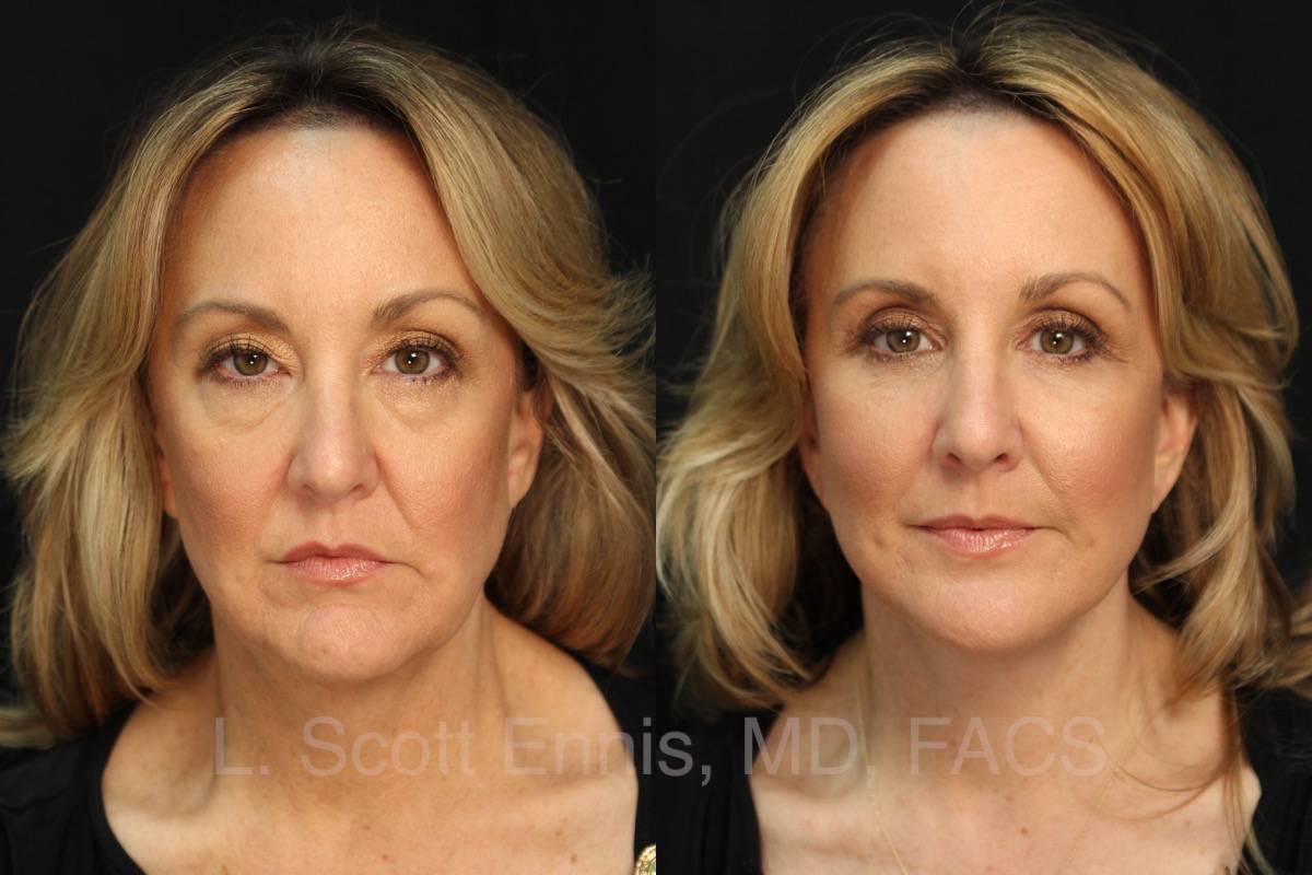 Before and After face lift eye lid lift blepheroplasty buccal fat pad removal mini Ennis Plastic Surgery Palm Beach Boca Raton Destin Miami Fort Lauderdale Florida