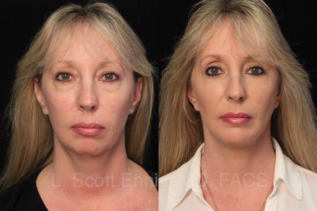 Faclift, Blepharoplasty & Chin Implant