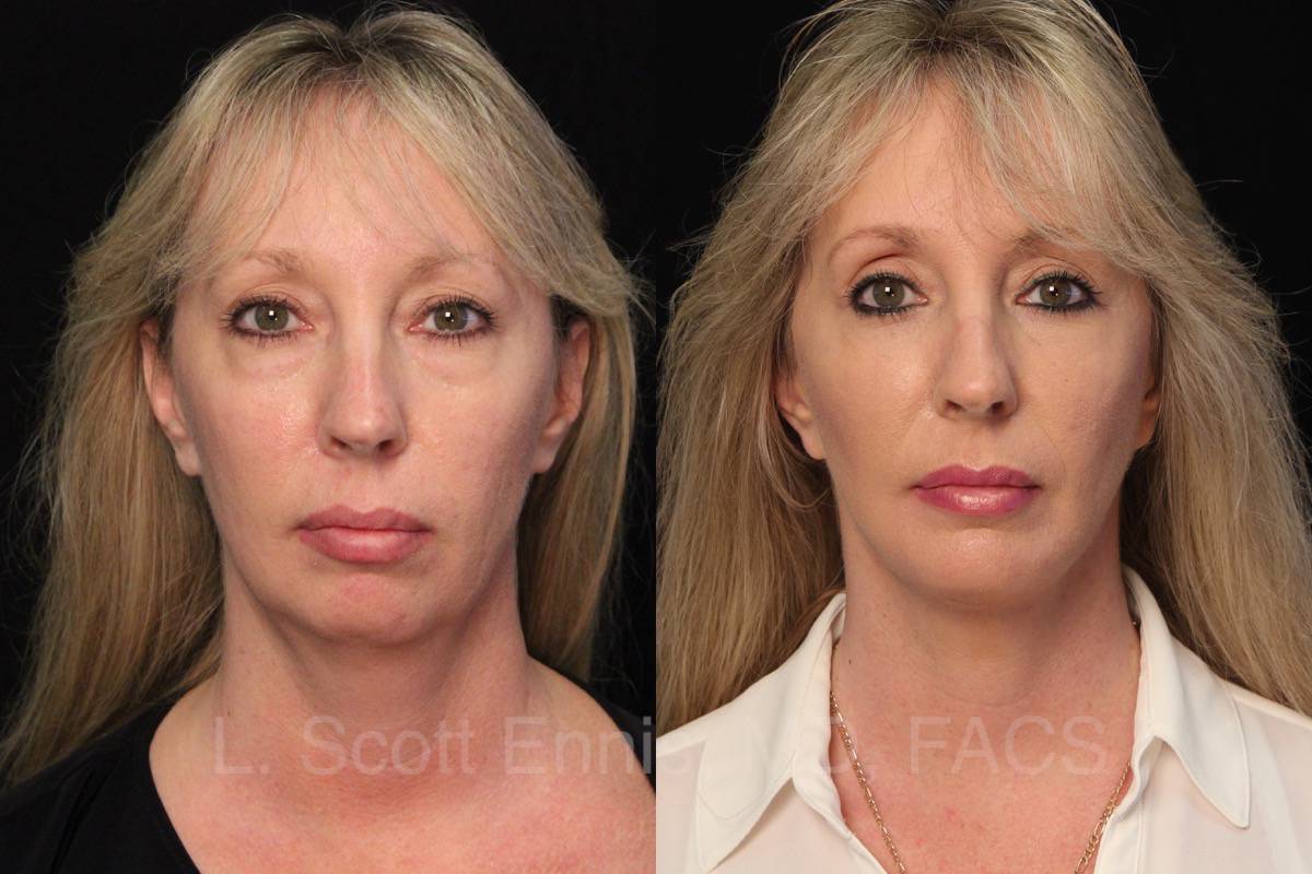 Before and After face lift eye lid lift blepheroplasty buccal fat pad removal mini chin implant Ennis Plastic Surgery Palm Beach Boca Raton Destin Miami Fort Lauderdale Florida
