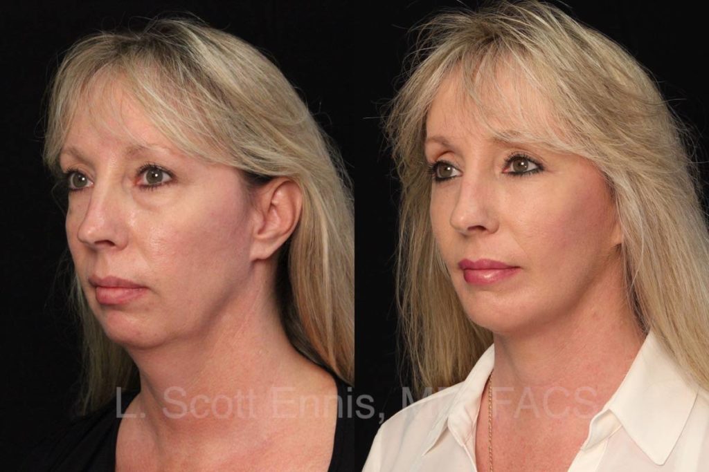 Faclift, Blepharoplasty & Chin Implant