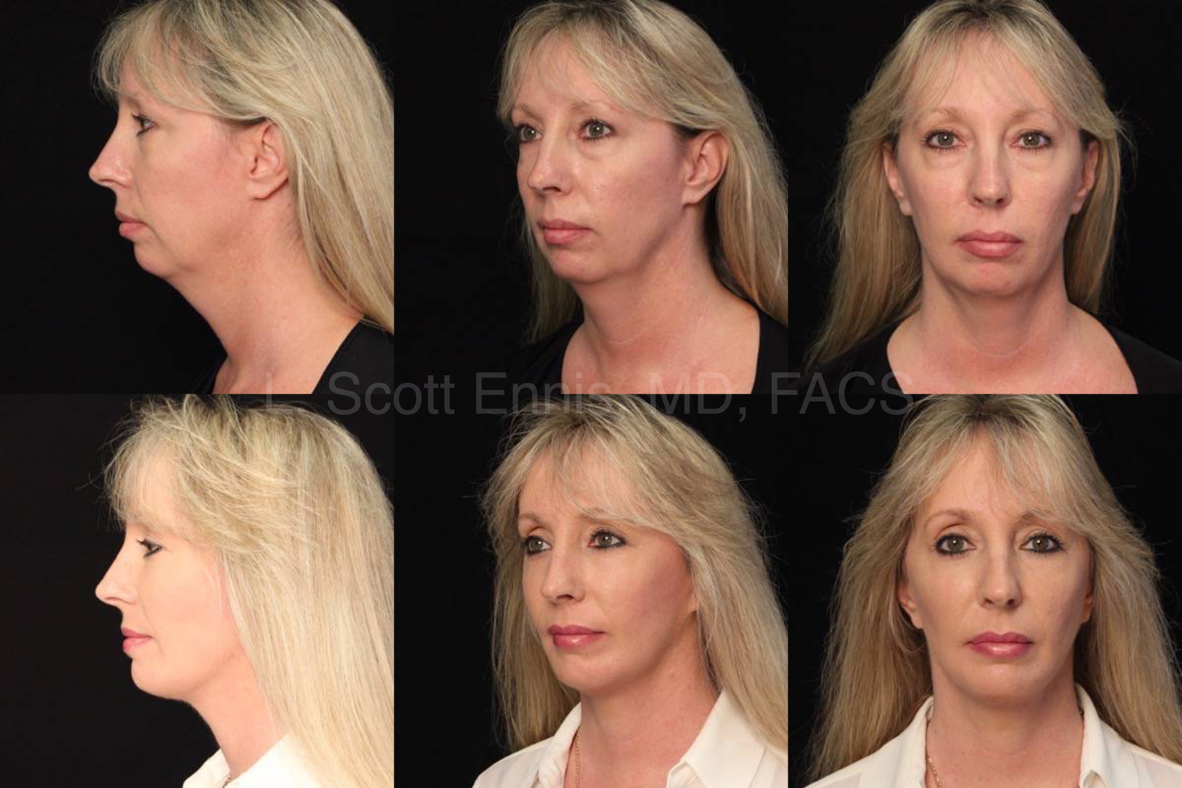 Before and After face lift eye lid lift blepheroplasty buccal fat pad removal mini chin implant Ennis Plastic Surgery Palm Beach Boca Raton Destin Miami Fort Lauderdale Florida