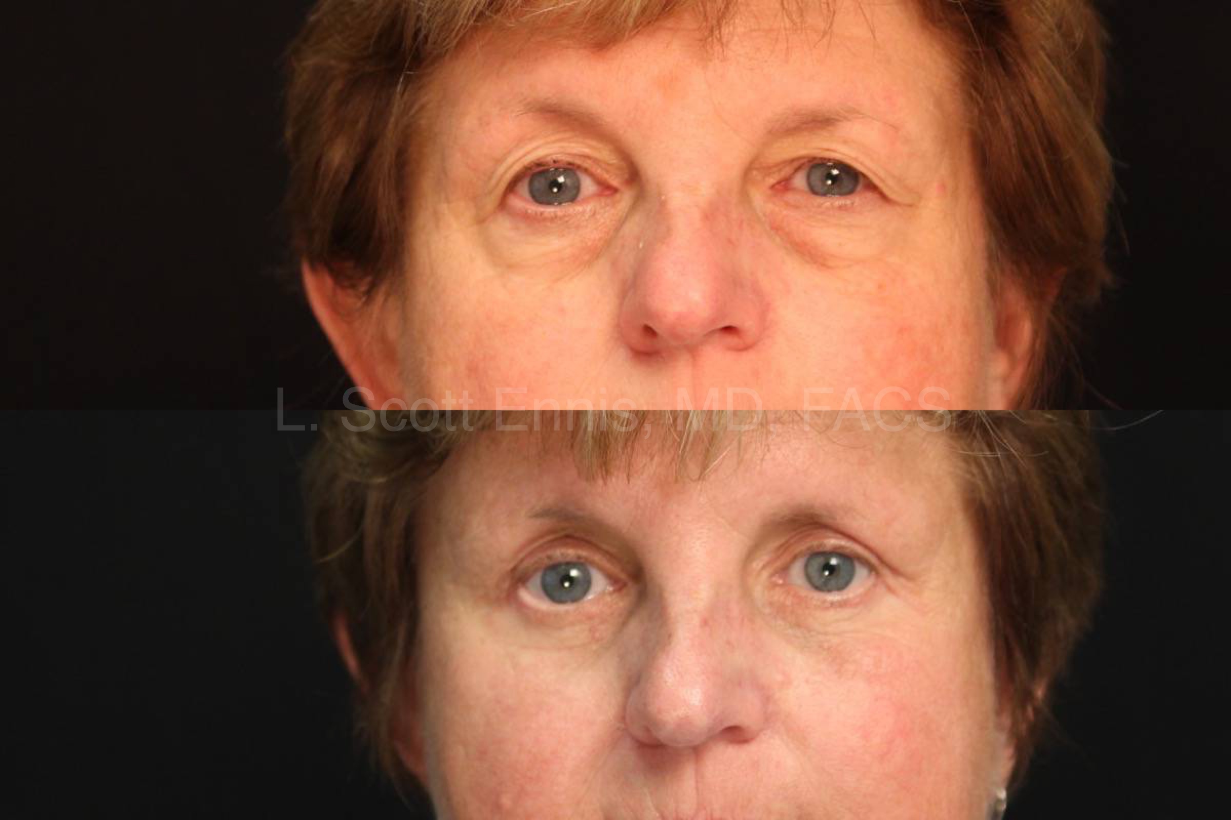 Before and After eye lid lift blepheroplasty Ennis Plastic Surgery Palm Beach Boca Raton Destin Miami Fort Lauderdale Florida