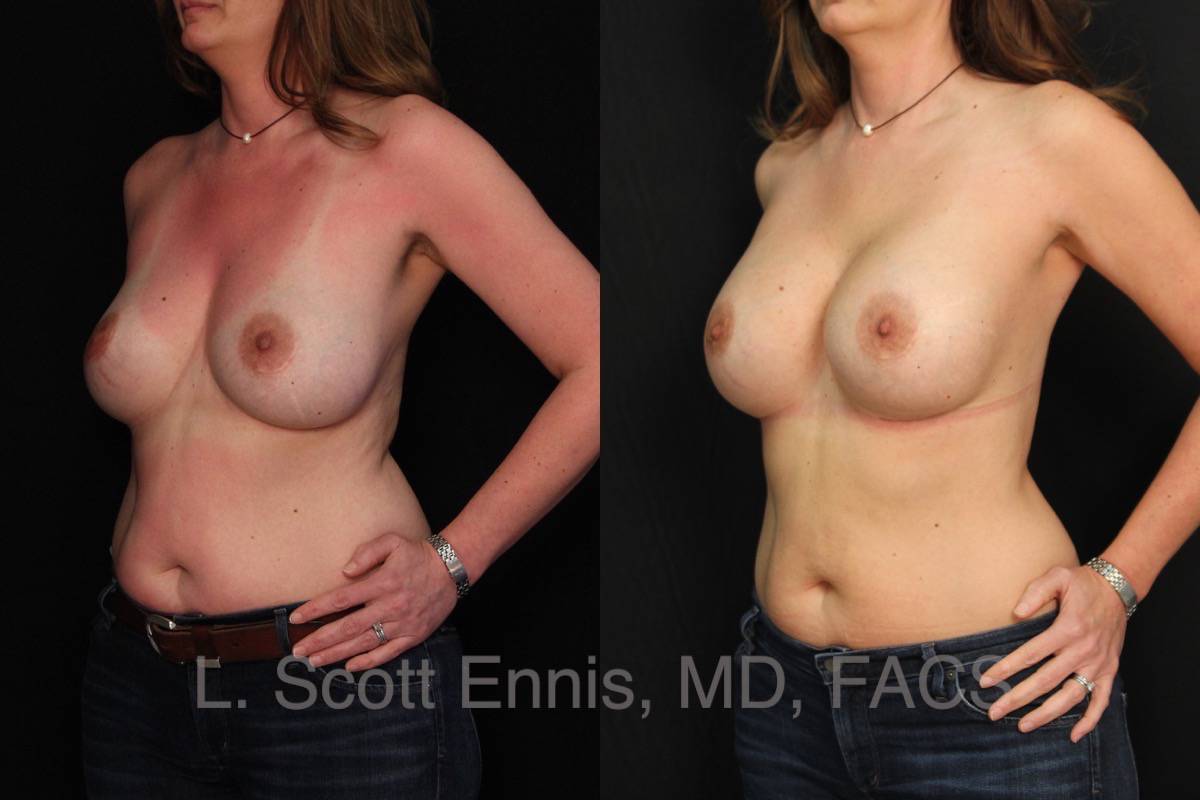 Before and After breast augmentation revision Ennis Plastic Surgery Palm Beach Boca Raton Destin Miami Fort Lauderdale Florida