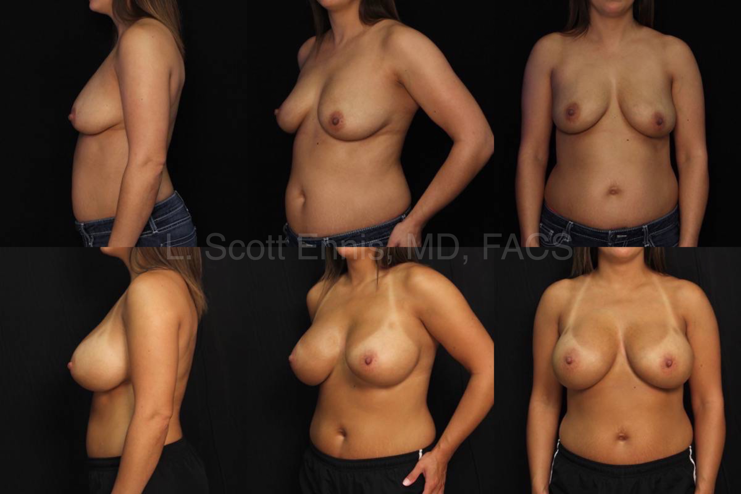 Before and After transaxillary breast augmentation Ennis Plastic Surgery Palm Beach Boca Raton Destin Miami Fort Lauderdale Florida