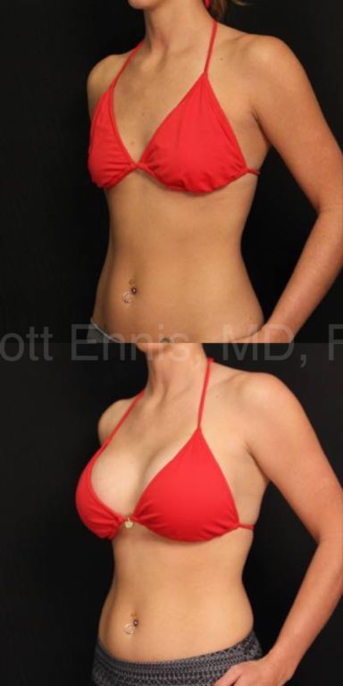 motiva-breast-implants-ergonomix-round-at-dr-ennis-in-florida