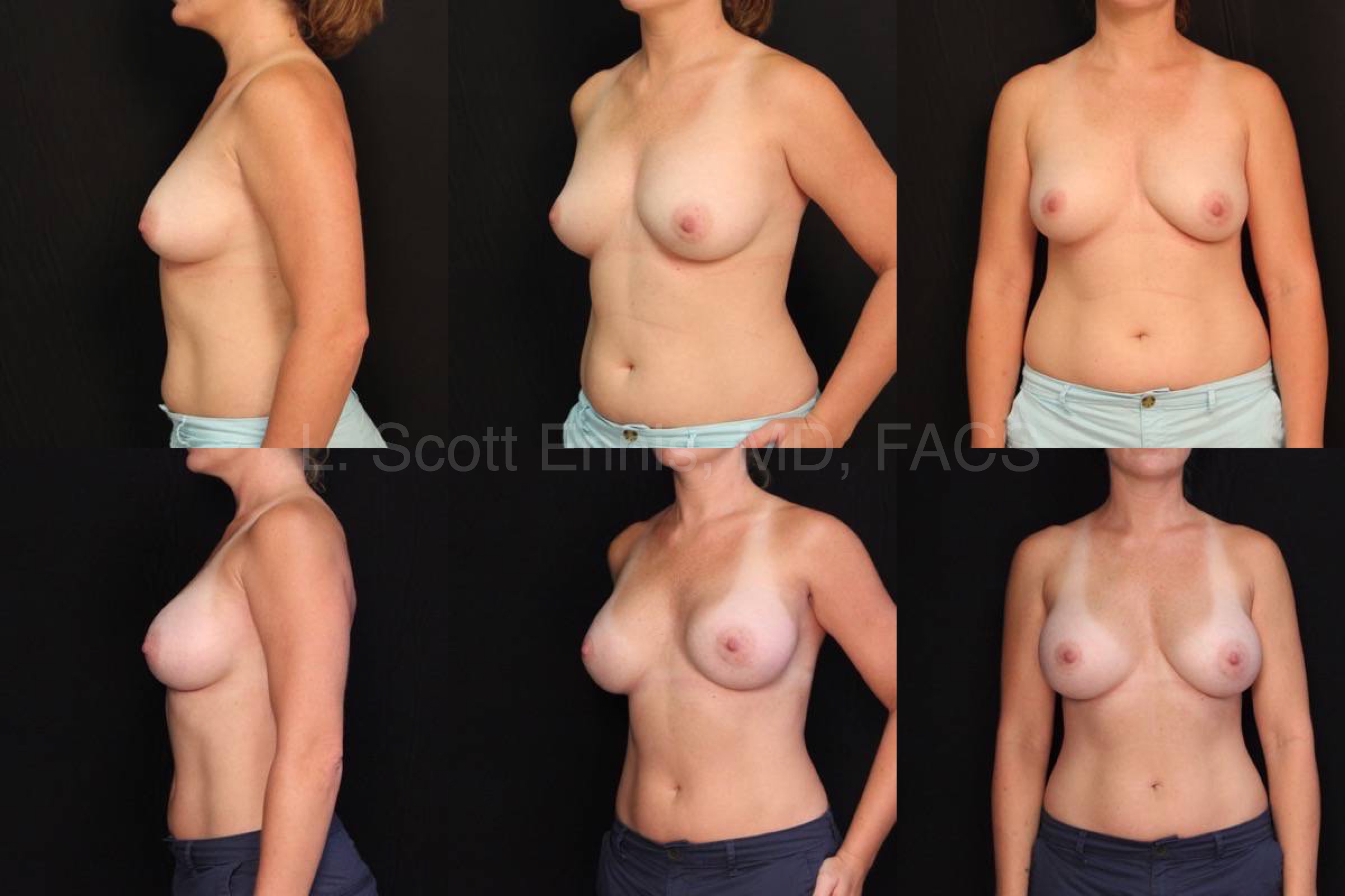 Endoscopic Transaxillary Breast Augmentation with Gel R400L350 Mod plus gel Before and After Ennis Plastic Surgery Palm Beach Boca Raton Destin Miami For Lauderdale Florida