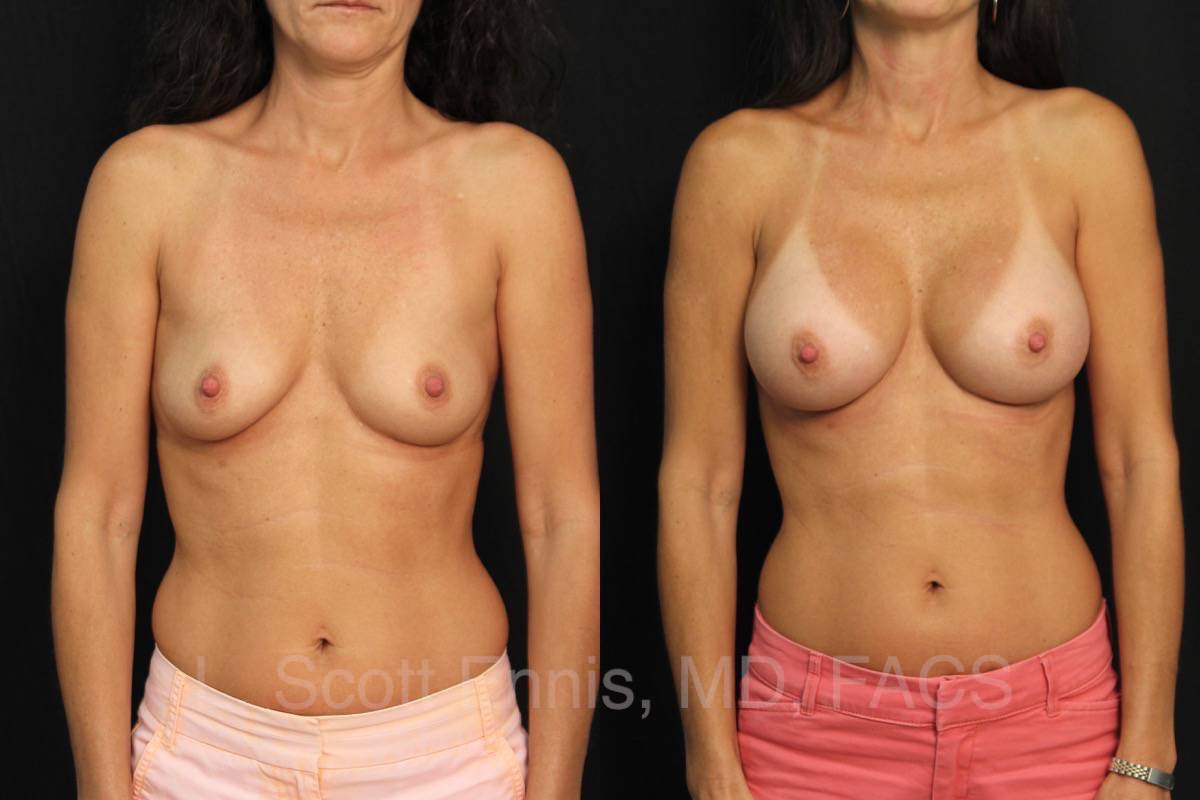 Endoscopic Transaxillary Breast Augmentation with gel R350 L300 moderate plus Before and After Ennis Plastic Surgery Palm Beach Boca Raton Destin Miami Fort Lauderdale Florida