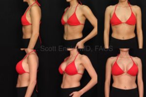 Endoscopic Transaxillary Breast Augmentation Endoscopic Mod+ gel L375 R350 Before and After Ennis Plastic Surgery Palm Beach Boca Raton Destin Miami Fort Lauderdale Florida