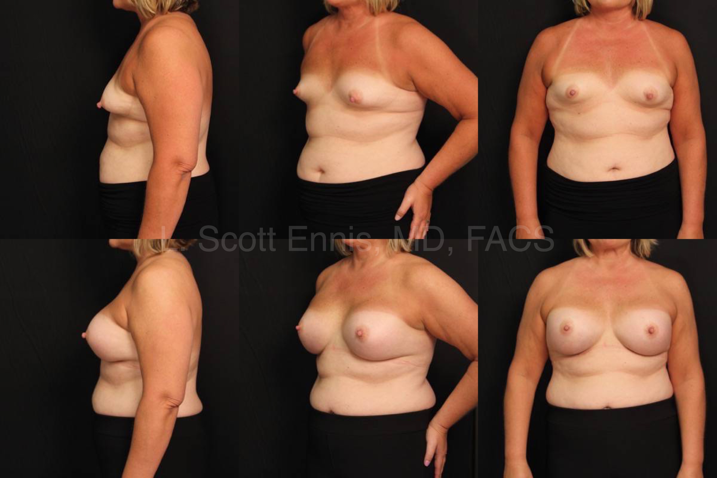 Endoscopic Transaxillary Breast Augmentation Mentor HP Gel R650_ L600 Before and After Ennis Plastic Surgery Palm Beach Boca Raton Destin Miami Fort Lauderdale Florida