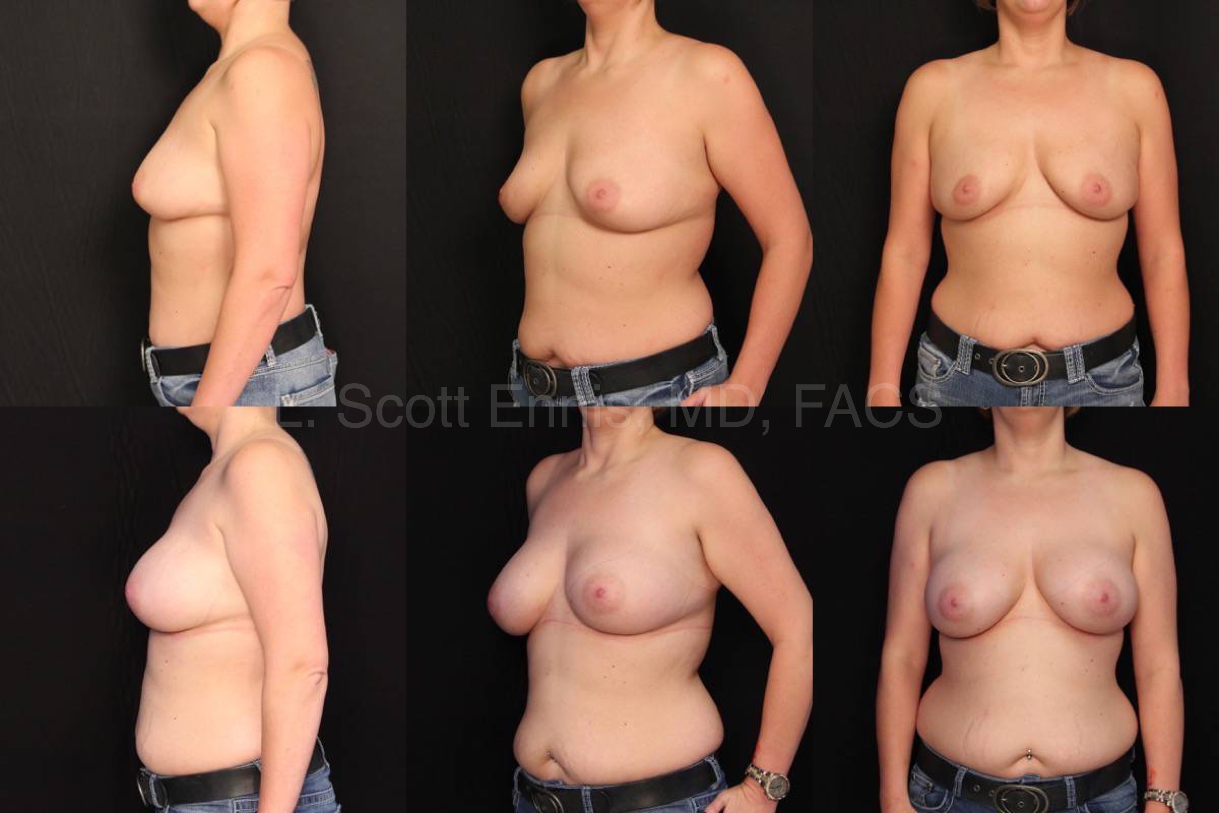 Endoscopic Transaxillary Breast Augmentation Mentor Moderate Plus R500 L450 Before and After Ennis Plastic Surgery Palm Beach Boca Raton Destin Miami Fort Lauderdale