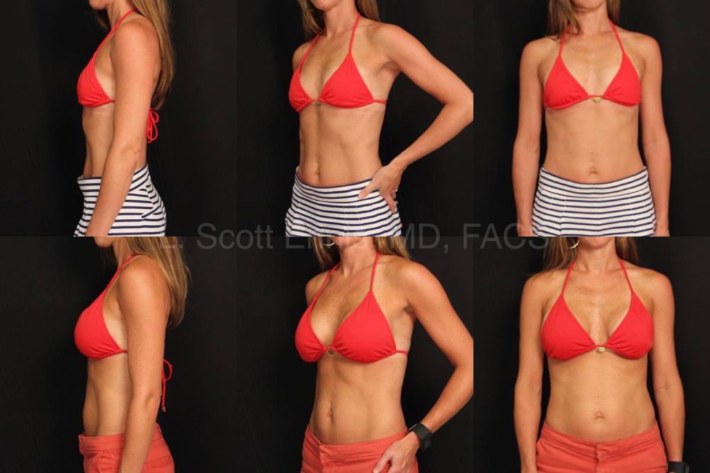 Endoscopic Transaxillary Breast Augmentation Mentor Smooth Moderate Plus Gel L350 R375 Before and After Ennis Plastic Surgery Palm Beach Boca Raton Destin Miami Fort Lauderdale