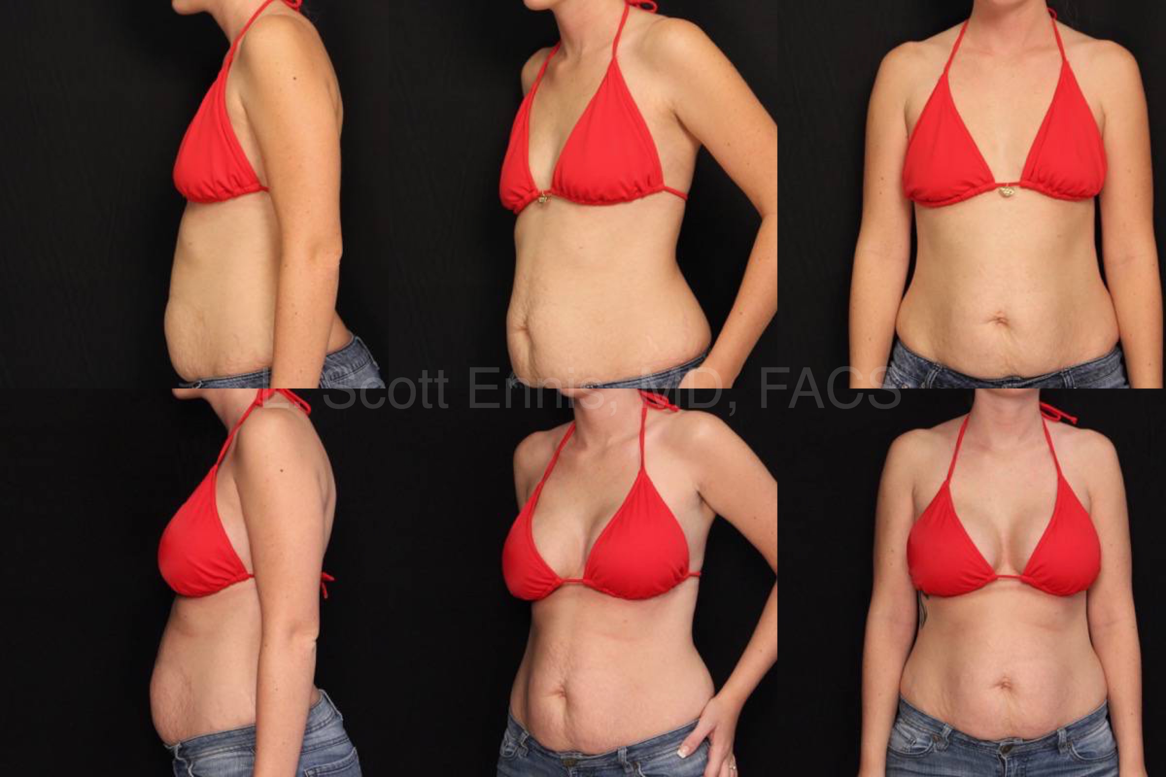 Endoscopic Transaxillary Breast Augmentation Sientra High Profile Gel R495 L465 Before and After Ennis Plastic Surgery Palm Beach Boca Raton Destin Miami Fort Lauderdale
