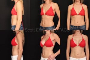 endoscopic transaxillary Breast Augmentation Sientra ModPlus Gel R440_ L410 Before and After Ennis Plastic Surgery Palm Beach Boca Raton Destin Miami Fort Lauderdale