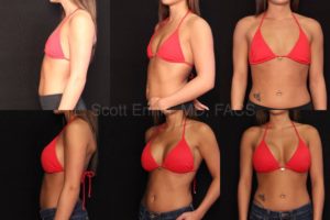 transaxillary Endoscopic Breast Augmentation Sientra ModPlus Bilateral Breast Aug with Gel R485 L485 Before and After Ennis Plastic Surgery Palm Beach Boca Raton Destin Miami Fort Lauderdale