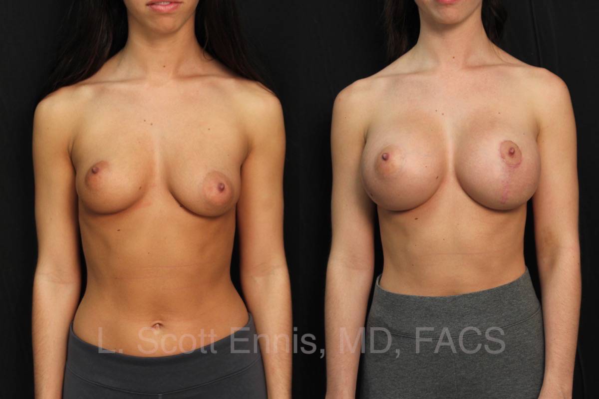 Left Breast Lift, Bilateral Breast Augmentation for correction of Asymmetry R475L425 HP gel Before and After Ennis Plastic Surgery Palm Beach Boca Raton Destin Miami Fort Lauderdale